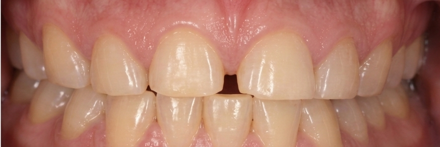 Close-up of front teeth before treatment, showing a visible gap between the two upper front teeth