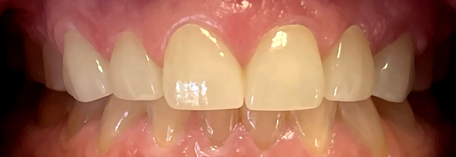 Same smile after treatment, with the front tooth gap closed and an even, natural-looking result
